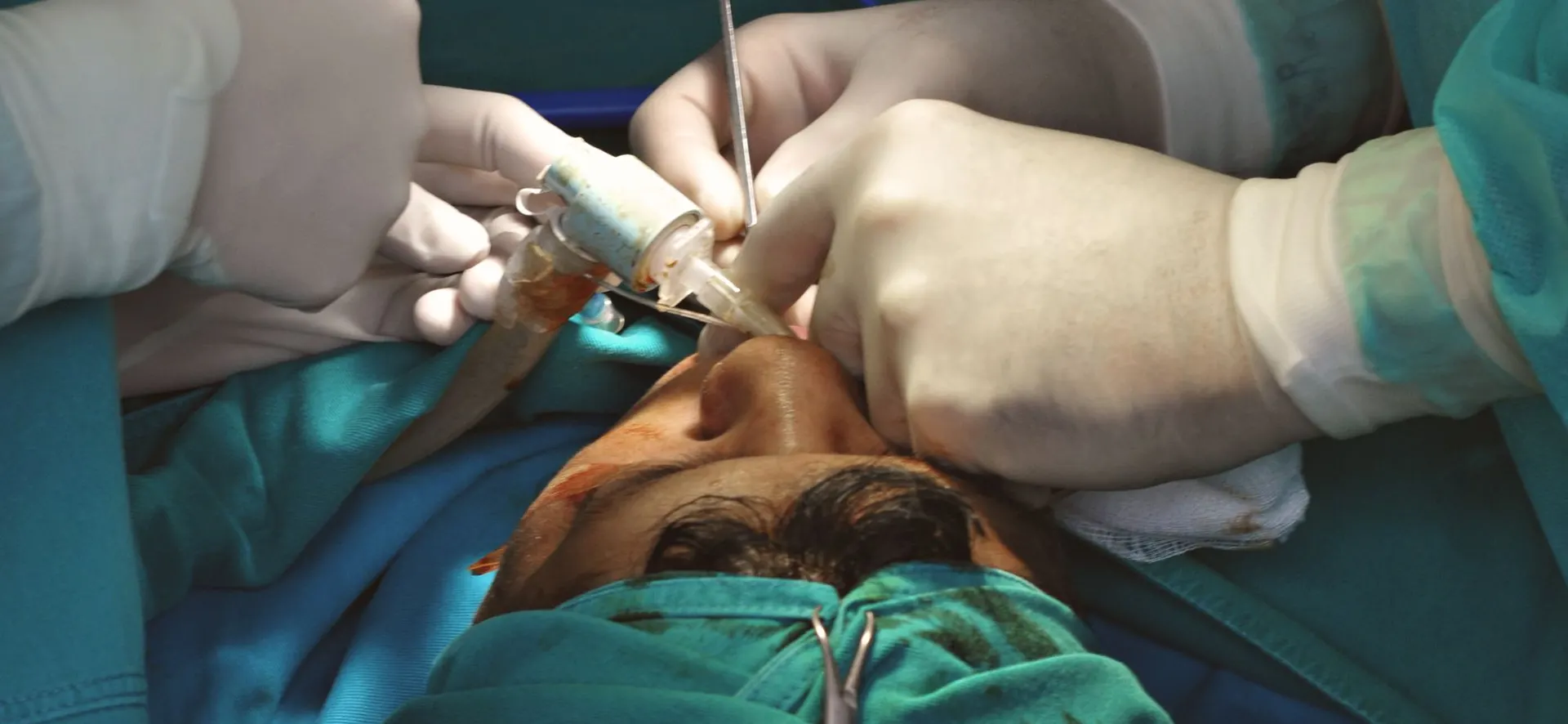 Ocular Surface Reconstruction in Turkey