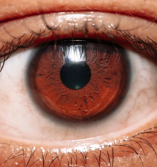 Severe Dry Eye and Limbal Stem Cell Deficiency