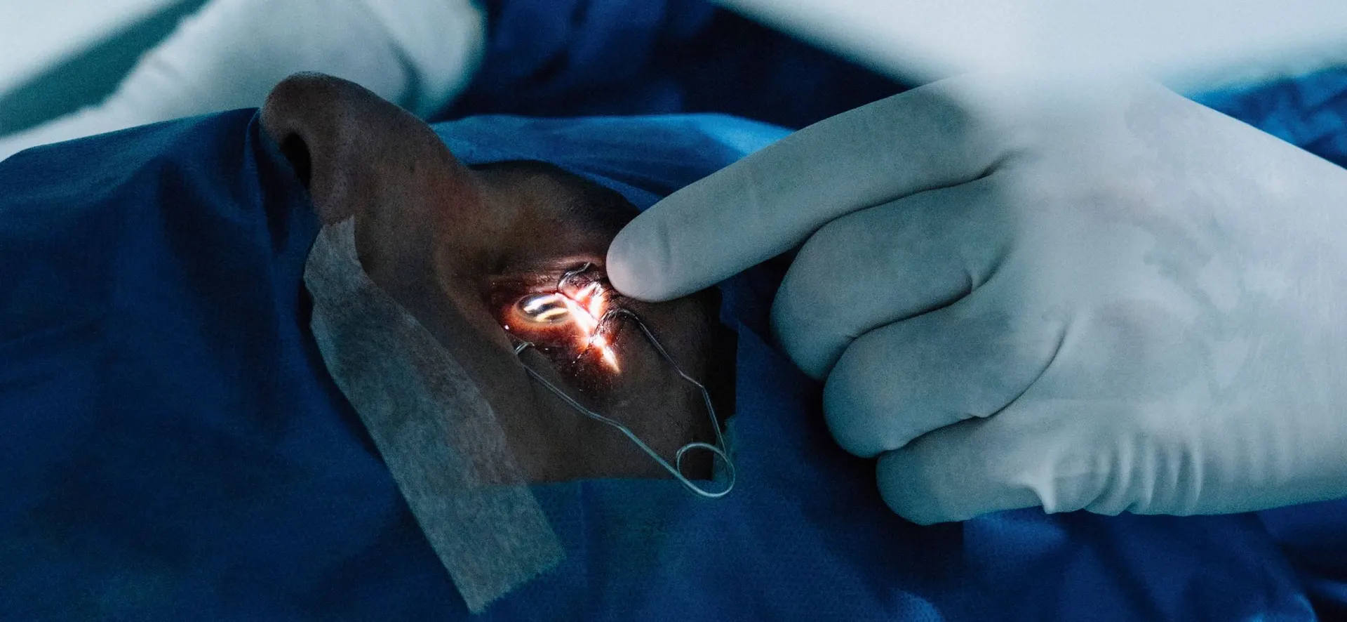 Pterygium Removal in Turkey