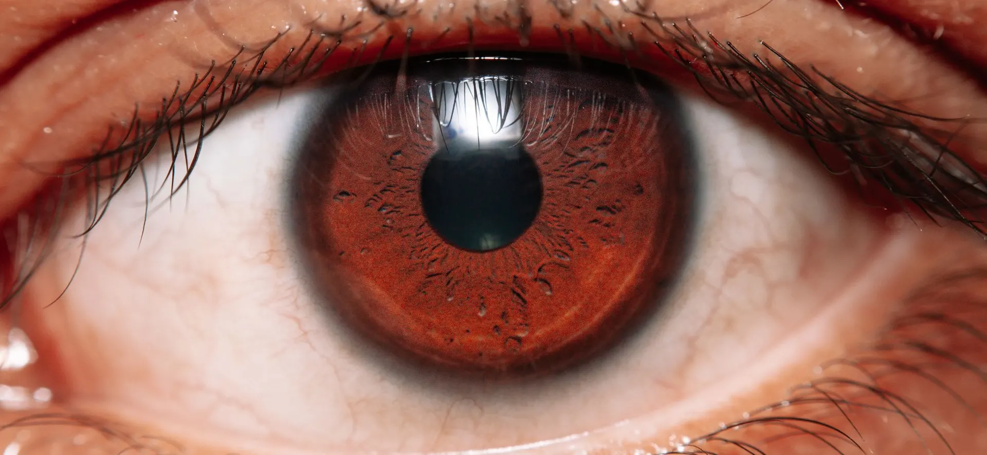 Uveitis Treatment in Turkey