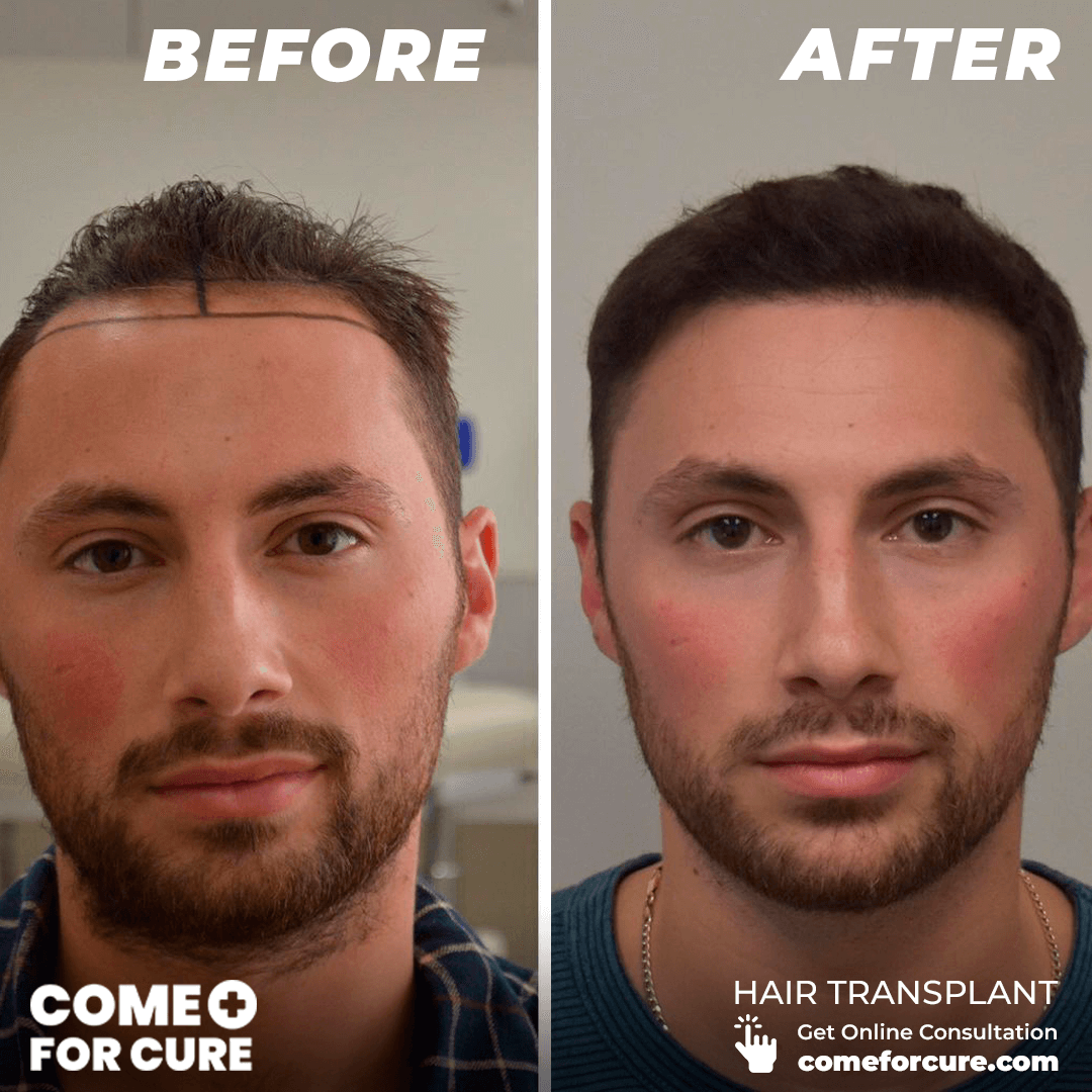 Hair Transplant Results - Come For Cure
